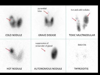 Example of thyroid uptake scan images 