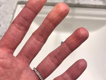 Raynauds