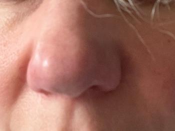 Rosacea across nose and face