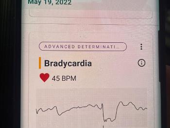 Bradycardia on kardiamobile. 
