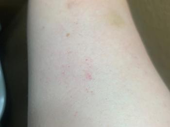 Red dots on arm