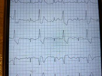 ECG 