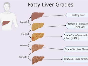 Fatty liver progression diagram