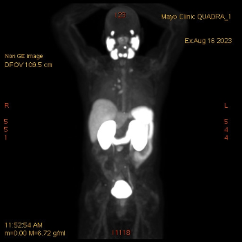 August 2023 PSMA Pet scan, after two treatments.