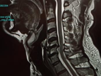 MRI of spinal stenosis 