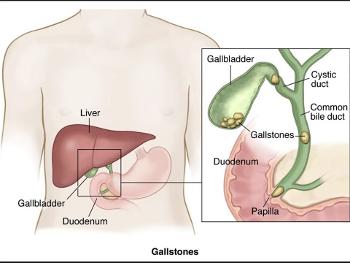 Gallstones in the bile duct