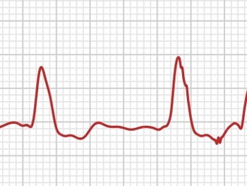 Apple Watch ECG showing ectopic beats and PQRST points.