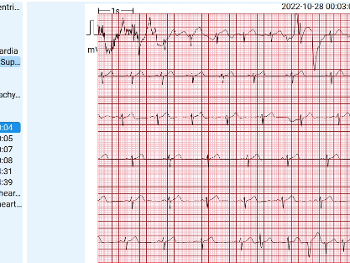 Summary of events with 400 pages of ECG