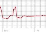 Apple ECG snipping showing multiple ectopic beats.