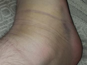 Ankle Injury Update 7-27-22