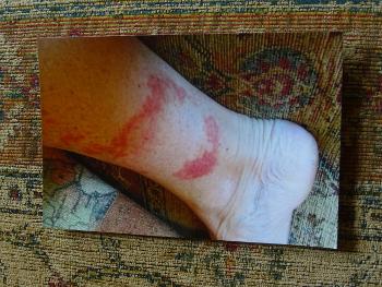 sudden appearance of a dark lower leg rash 