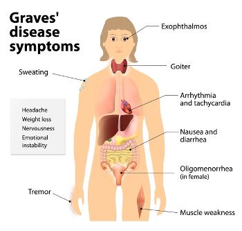 Image showing areas of the body affected by Graves Disease