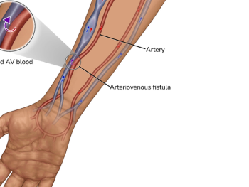 Fistula 