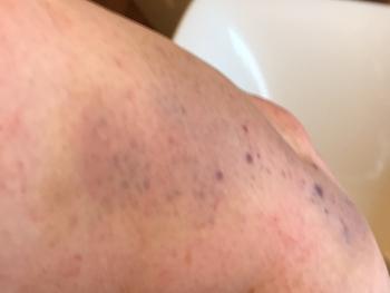 Bruise on elbow