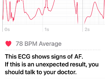 ECG from my Apple Watch can get a printout via My Phone from PDF file for the GP.
