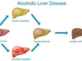Alcohol related liver disease progression.