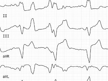 Screenshot of ecg 