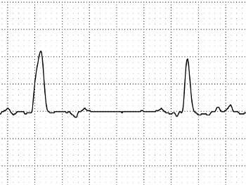 ECG strip showing "wide QRS" from LBBB and "missed" atrial ectopic beats.