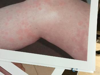 Urticaria photo