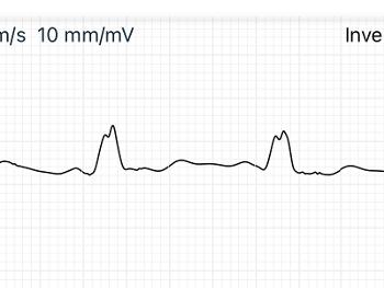 Close up of ecg showing wide QRS