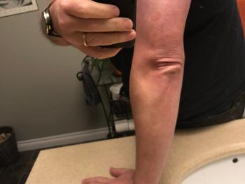 Red urticaria spots on right arm