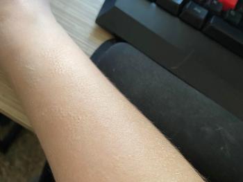 Weird patches of goosebumps on my right forearm