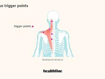 Illustration of Trapezius trigger points