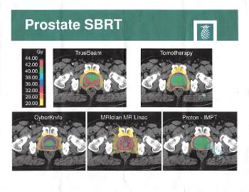 SBRT Prostate Radiation Treatment Exposure