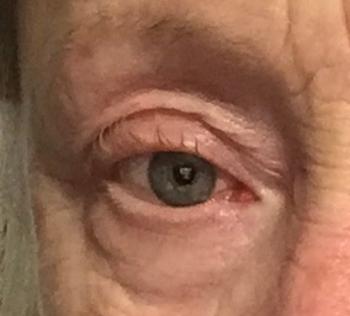 Droopy soft tissues around my eyes, like this 20+ years (since my early 40s)
