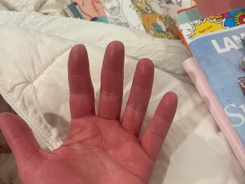hand swelling, erythema/redness, most pronounced on the palms of the hands. 