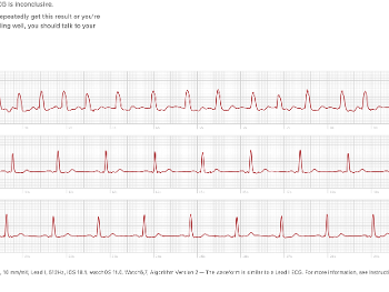 Apple ECG showing "micro AF".