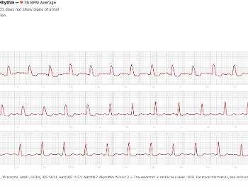 ECG showing NSR with LBBB