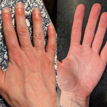 Erythromelalgia in hands 