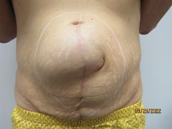 Before the surgery: hernia which was getting larger all the time