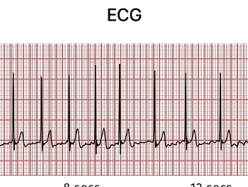 Afib