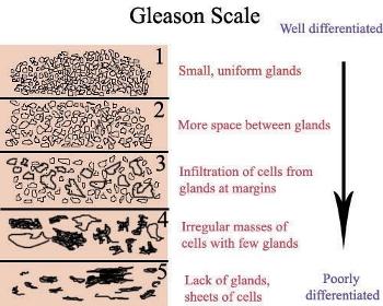 gleason score chart