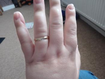 This is my lymphoedema hand 