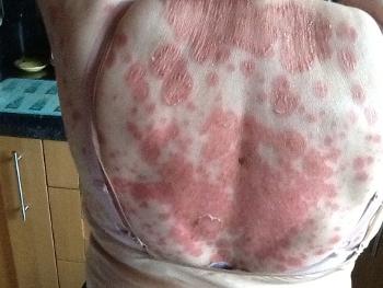 Lupus rash on back