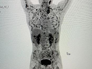 PET-CT imaging using RFP 18F-FDG of a patient with prostate cancer.