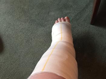 Bandaged leg
