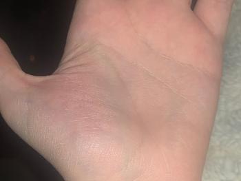 Lump on thumb 