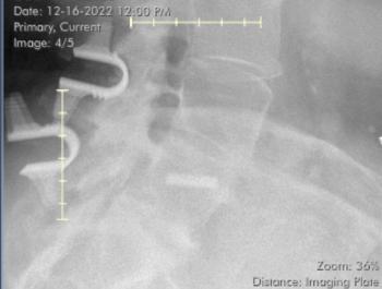 Two Coflex in back. Bottom one is not in the spine. Radiologist said nothing about it. 