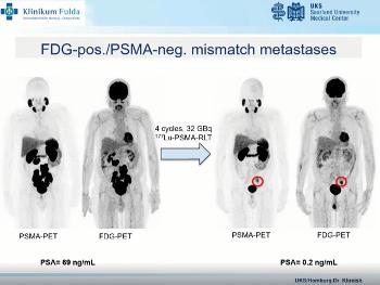 Case study of a patient with PSMA negative mets responding to Lu177 therapy.