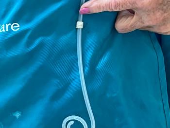 PD Catheter showing curl at bottom and "cuffs".