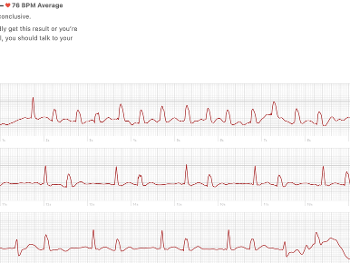 Apple ECG showing multiple ectopic beats.