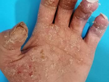 Colour photo of contact dermatitis on left hand and fingers. Open wounds. 