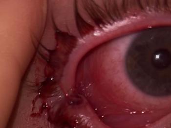 bleeding eye lid
