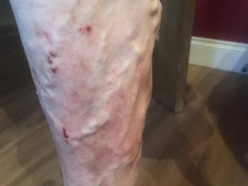 Varicose veins and irritation on leg