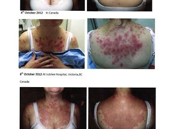 Progression of Lupus rash.