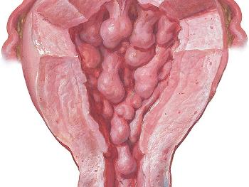 Uterus filled with polyps